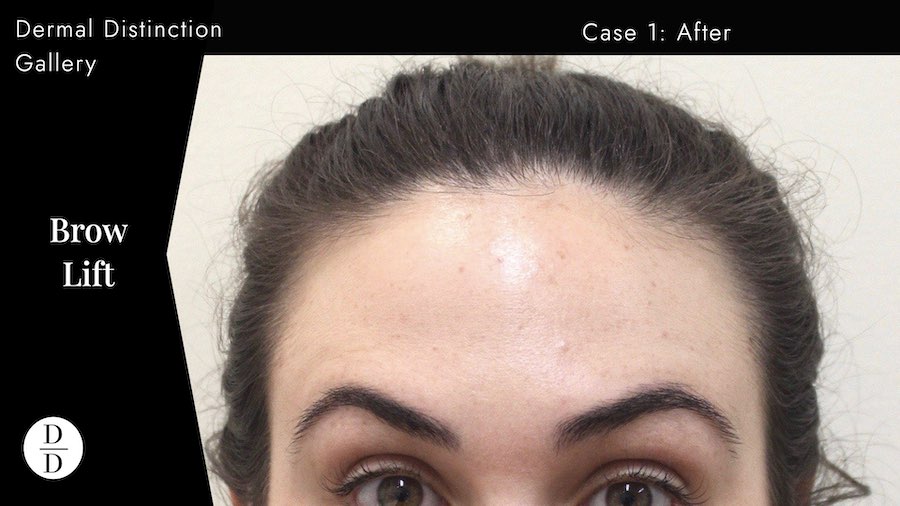 brow lift treatment Melbourne after
