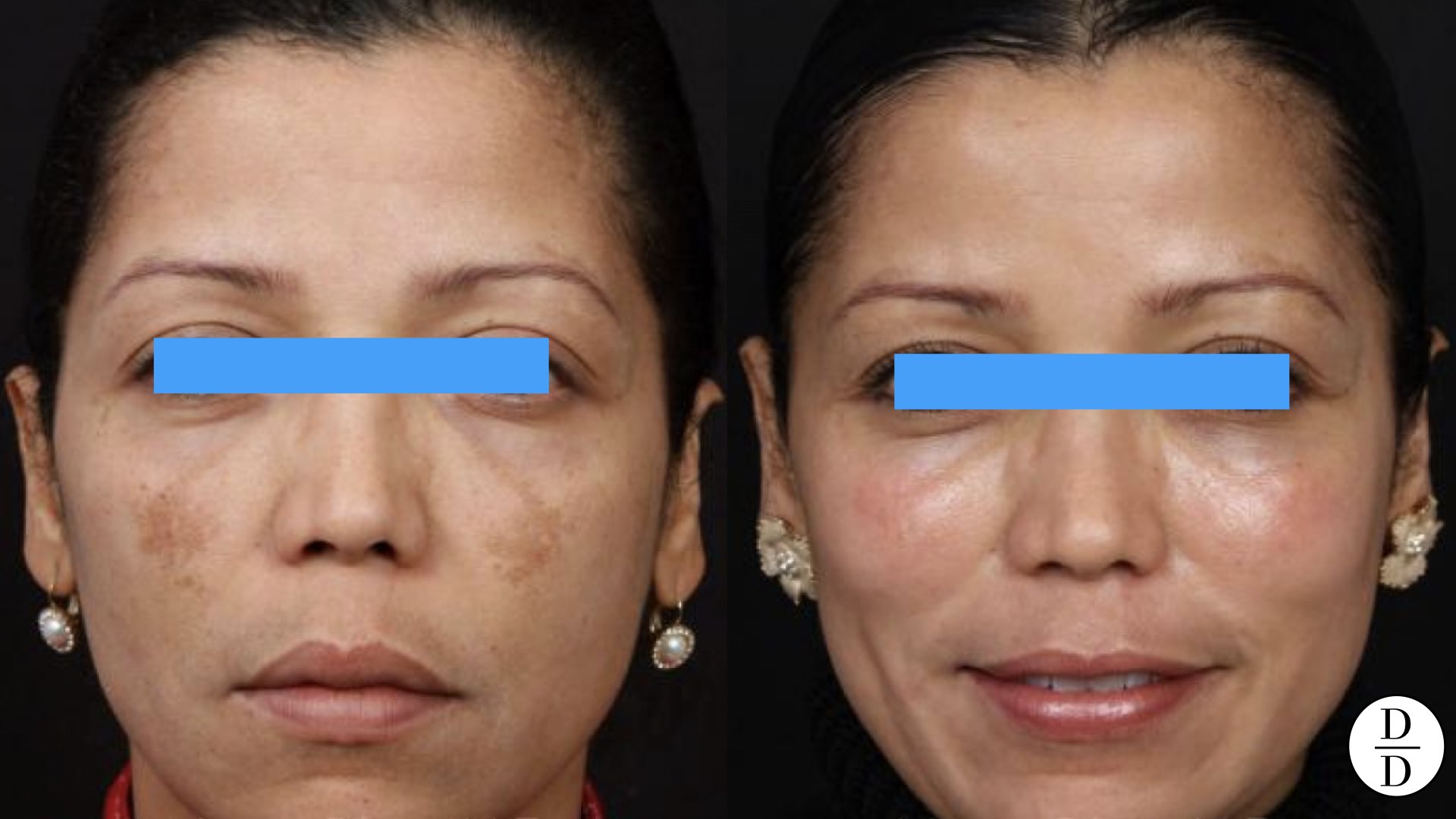 cosmelan results melbourne before and adter