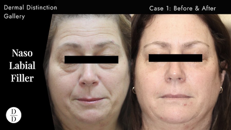 nasolabial filler in Balwyn before and adter