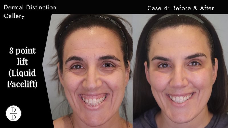 facial rejuvenation balwyn