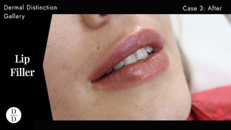 Lip filler in balwyn before and after
