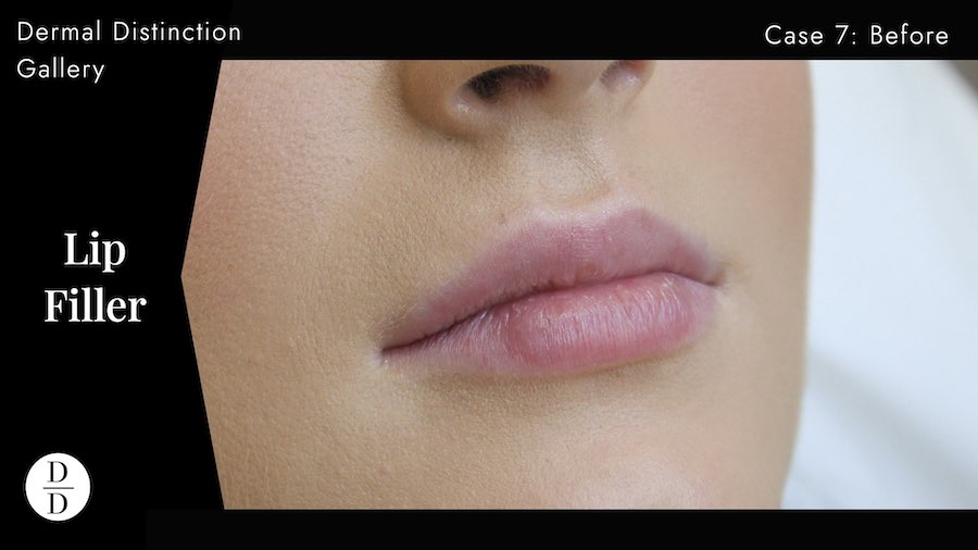 Lip filler in balwyn before and after