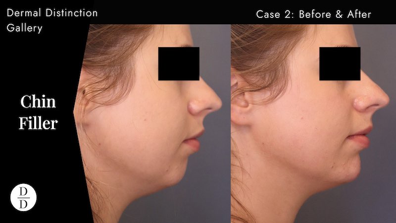 CHIN FILLER BEFORE & AFTER
