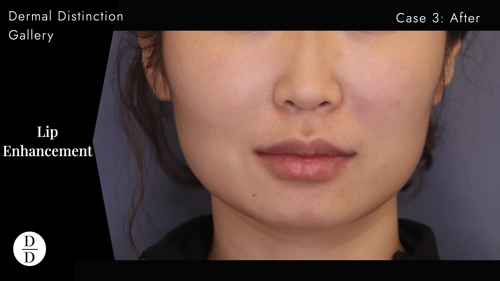 natural asian lip filler before and after melbourne