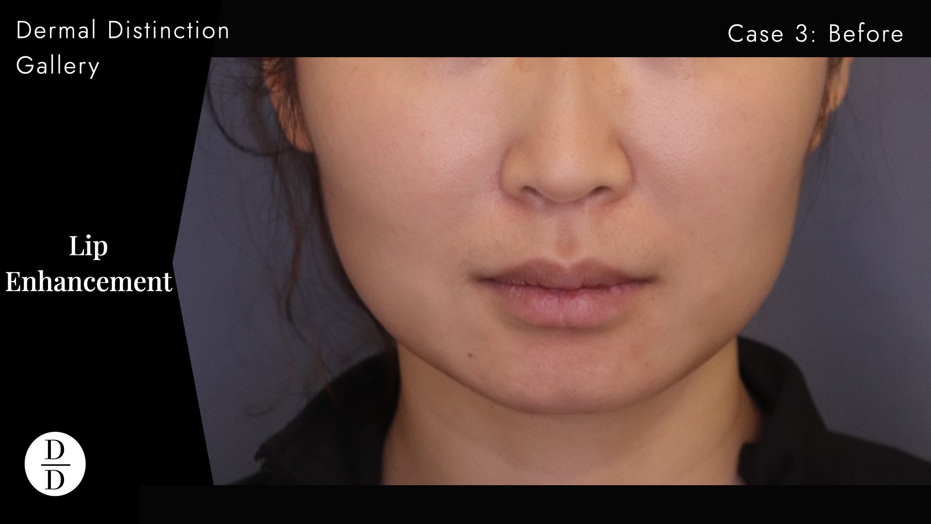 natural asian lip filler before and after melbourne