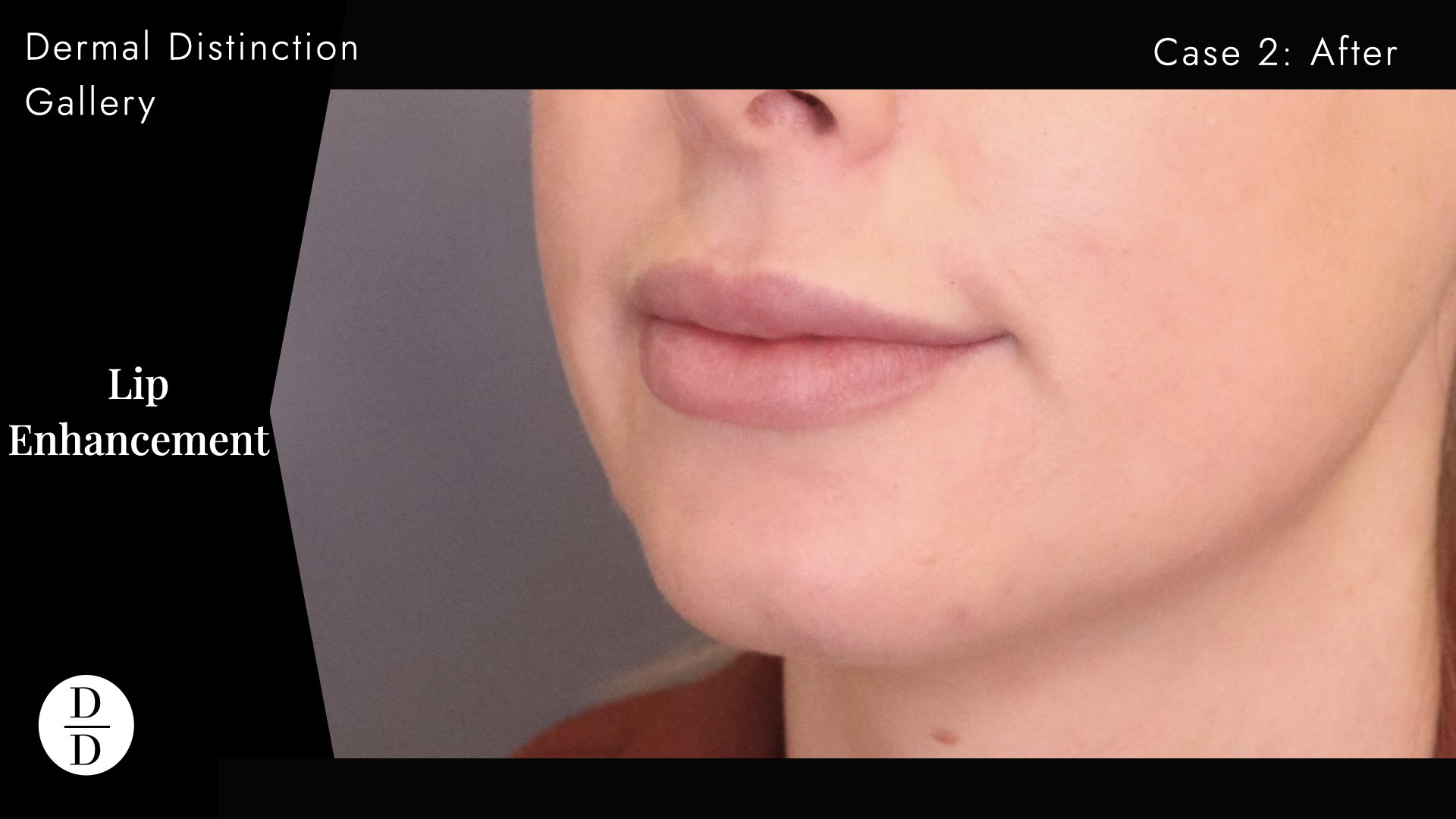 natural lip filler before and after melbourne