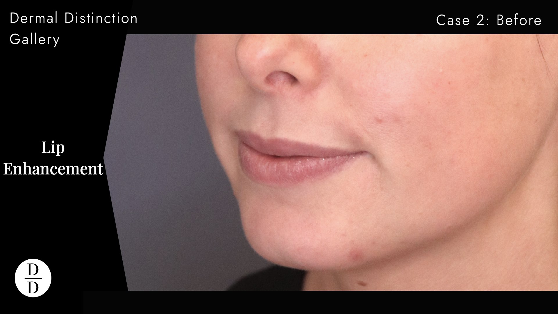 natural lip filler before and after melbourne
