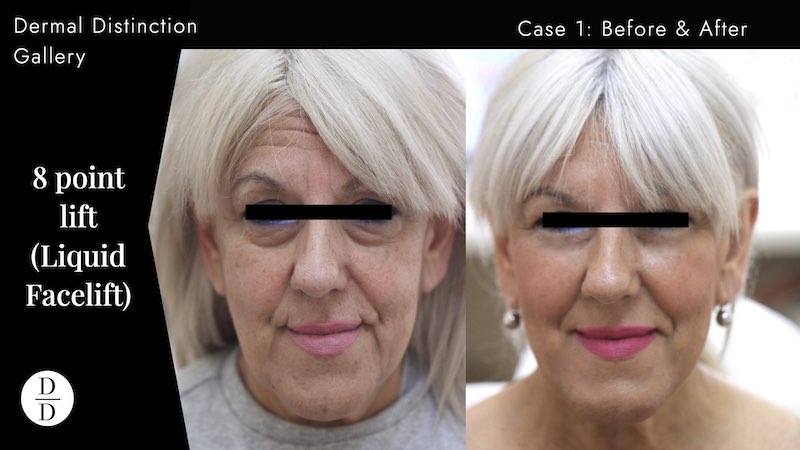 facial rejuvenation treatment Balwyn