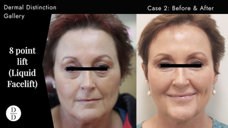 8-point lift before and after liquid facelift